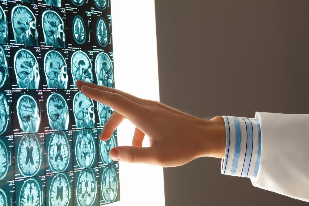 Photo of brain injury